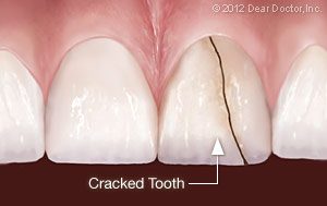 https://www.drjohnconness.com/wp-content/uploads/2019/02/cracked-tooth-1-300x189.jpg
