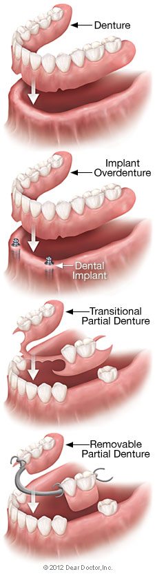 Fixing Cracked Teeth in Ottawa and Streator, IL