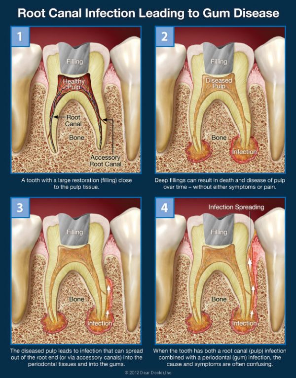 is-it-a-root-canal-infection-gum-problems-or-both